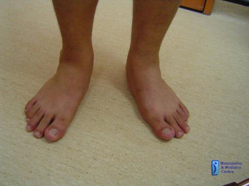 phoca thumb l pronated-feet